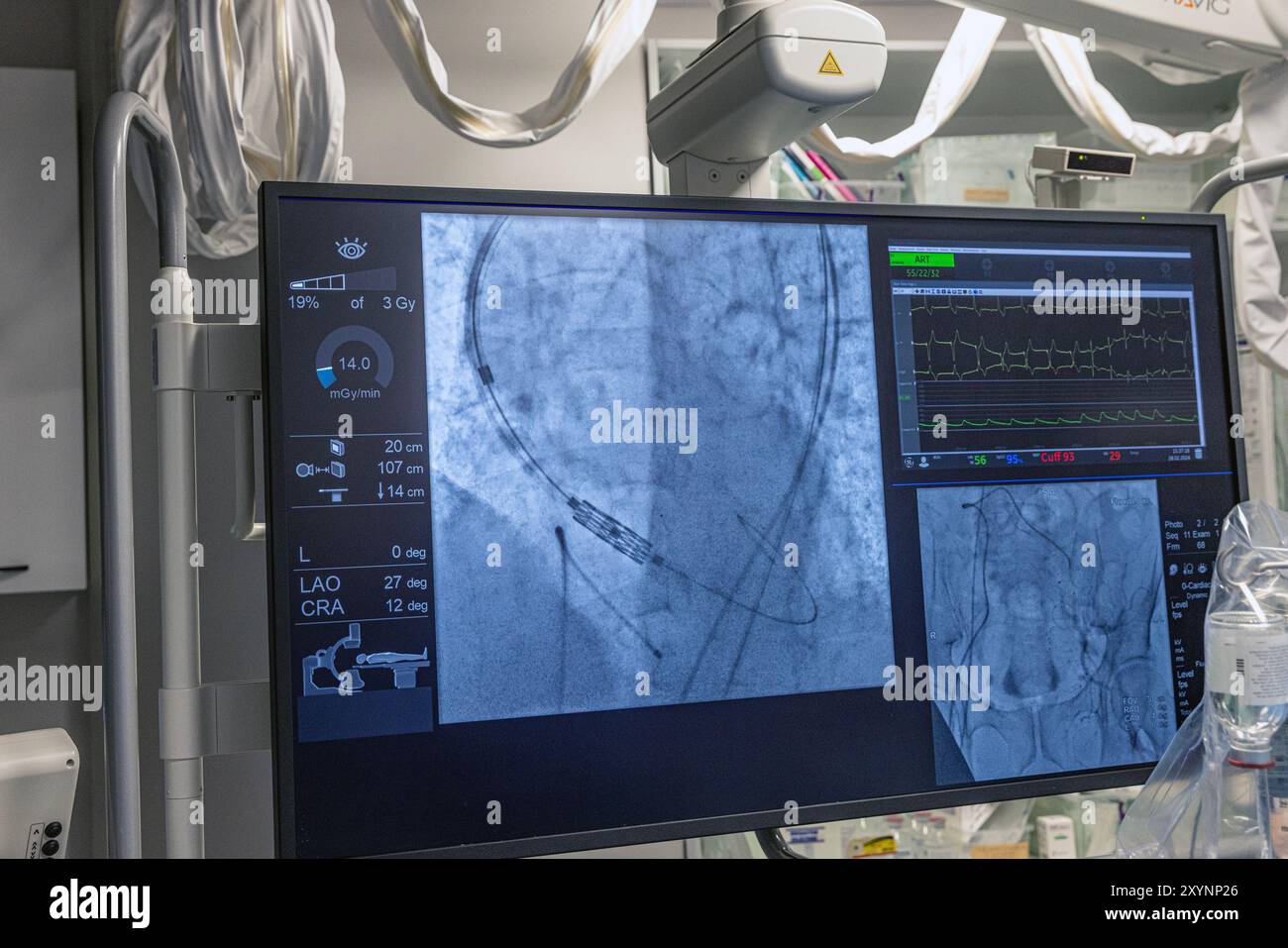 Istanbul, Turquie 29 février 2024 ; radiographie pour remplacement valvulaire avec valve mélodique. Vue d'une dysfonction valvulaire prothétique chez un patient atteint de mi Banque D'Images