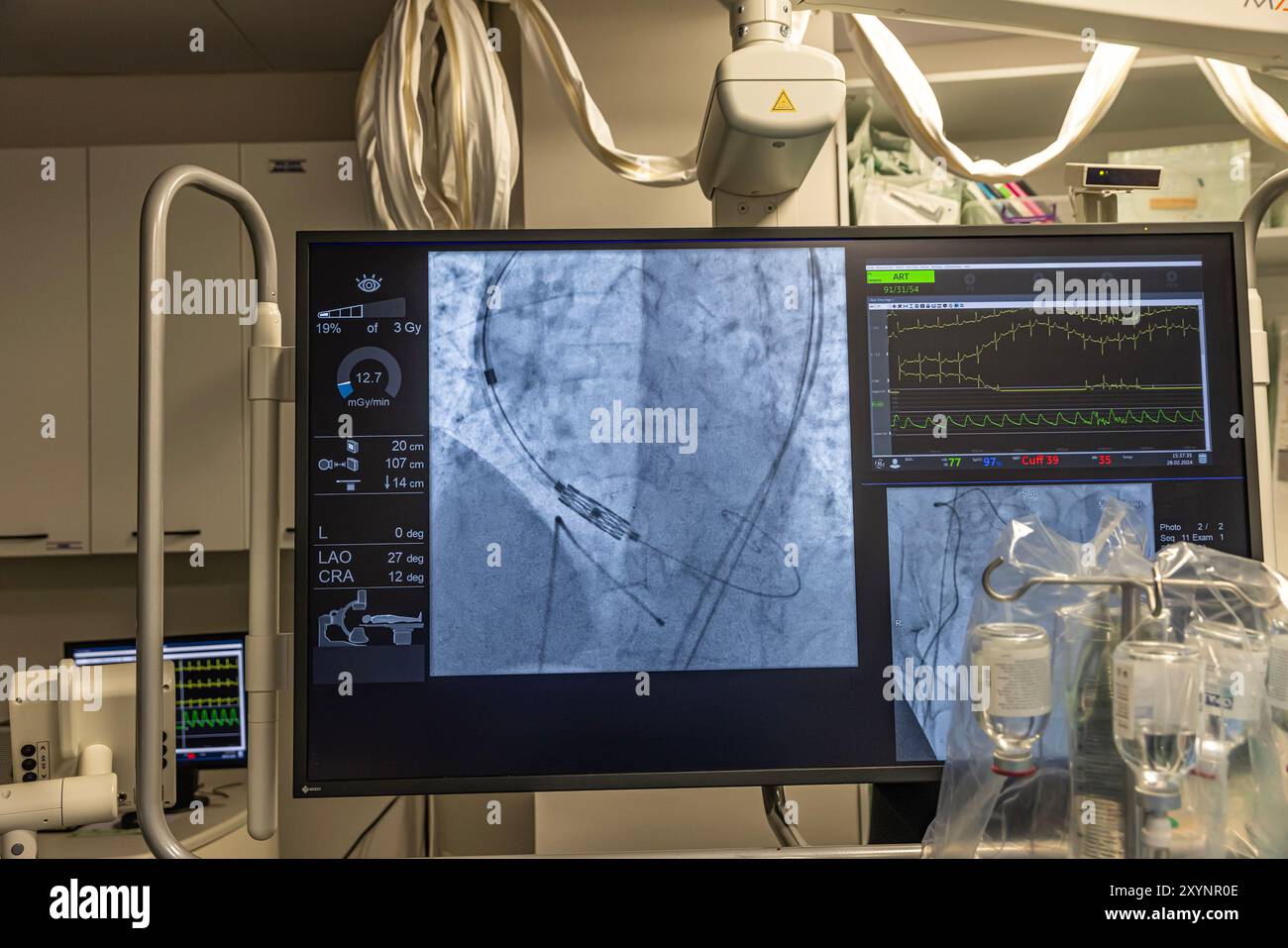 Istanbul, Turquie 29 février 2024 ; radiographie pour remplacement valvulaire avec valve mélodique. Vue d'une dysfonction valvulaire prothétique chez un patient atteint de mi Banque D'Images