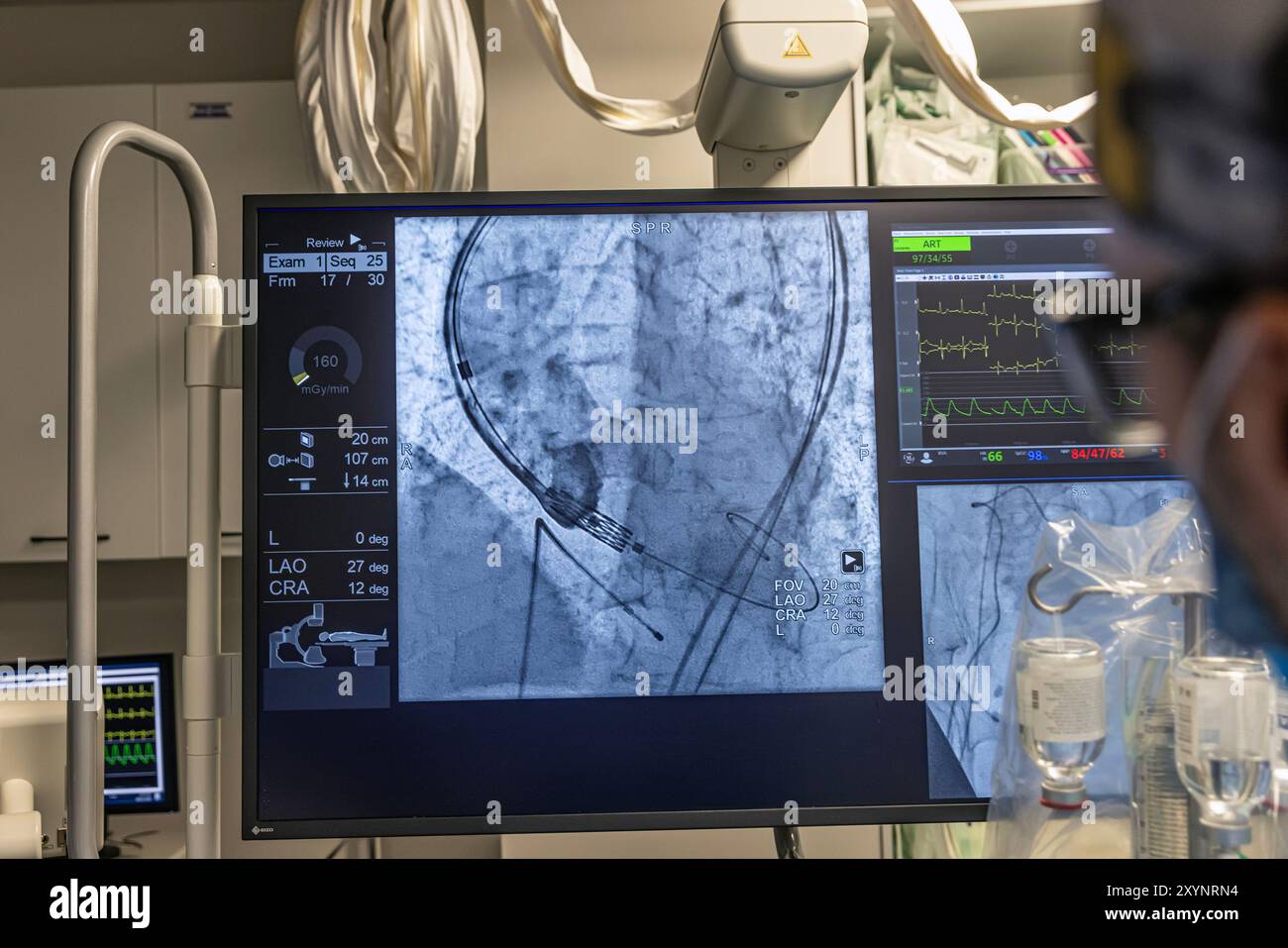 Istanbul, Turquie 29 février 2024 ; radiographie pour remplacement valvulaire avec valve mélodique. Vue d'une dysfonction valvulaire prothétique chez un patient atteint de mi Banque D'Images