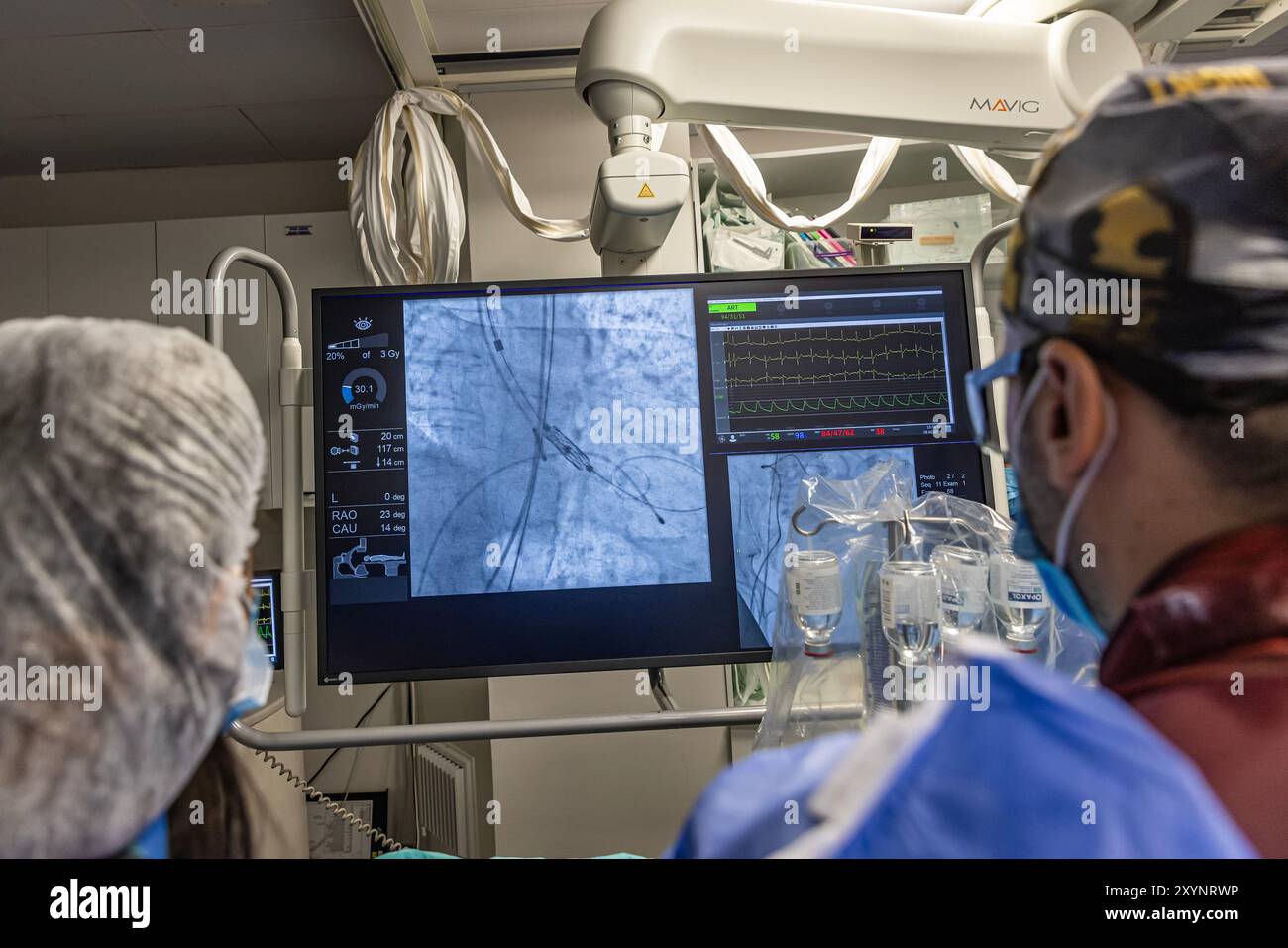 Istanbul, Turquie 29 février 2024 ; radiographie pour remplacement valvulaire avec valve mélodique. Vue d'une dysfonction valvulaire prothétique chez un patient atteint de mi Banque D'Images