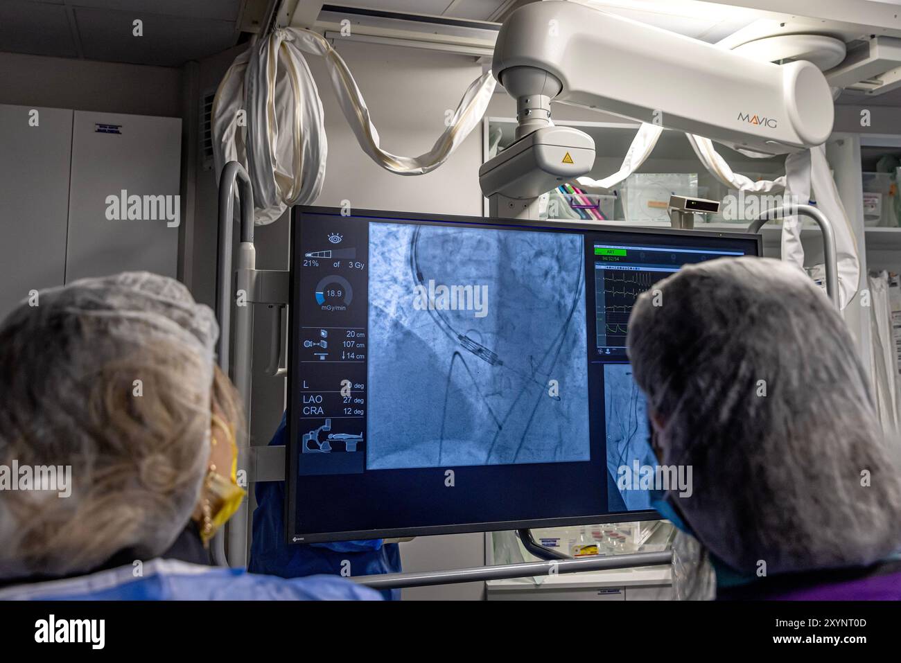 Istanbul, Turquie 29 février 2024 ; radiographie pour remplacement valvulaire avec valve mélodique. Vue d'une dysfonction valvulaire prothétique chez un patient atteint de mi Banque D'Images