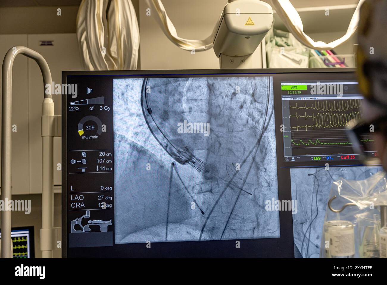 Istanbul, Turquie 29 février 2024 ; radiographie pour remplacement valvulaire avec valve mélodique. Vue d'une dysfonction valvulaire prothétique chez un patient atteint de mi Banque D'Images