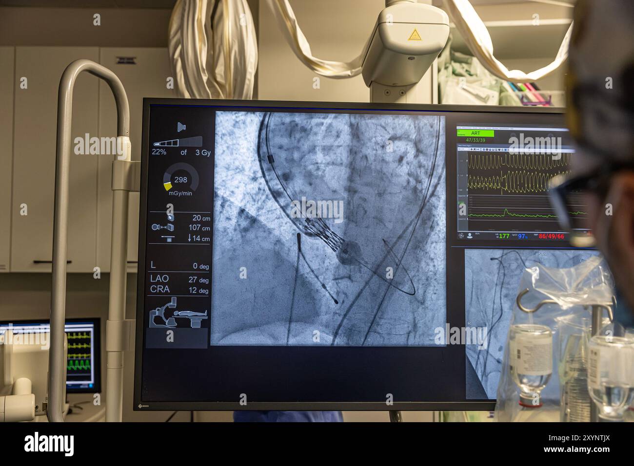 Istanbul, Turquie 29 février 2024 ; radiographie pour remplacement valvulaire avec valve mélodique. Vue d'une dysfonction valvulaire prothétique chez un patient atteint de mi Banque D'Images