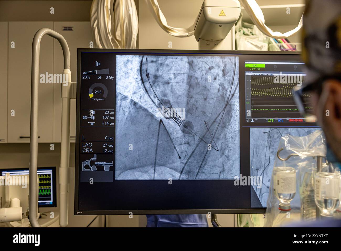 Istanbul, Turquie 29 février 2024 ; radiographie pour remplacement valvulaire avec valve mélodique. Vue d'une dysfonction valvulaire prothétique chez un patient atteint de mi Banque D'Images