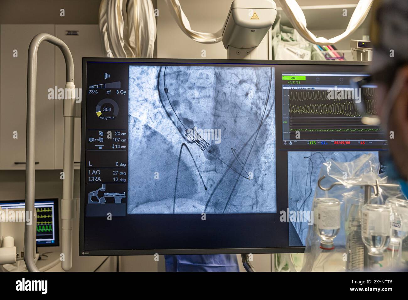 Istanbul, Turquie 29 février 2024 ; radiographie pour remplacement valvulaire avec valve mélodique. Vue d'une dysfonction valvulaire prothétique chez un patient atteint de mi Banque D'Images