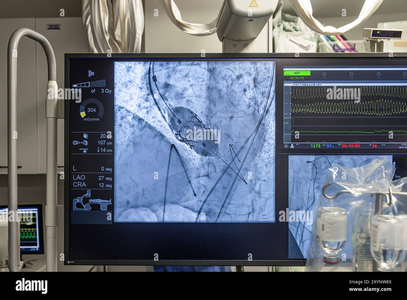 Istanbul, Turquie 29 février 2024 ; radiographie pour remplacement valvulaire avec valve mélodique. Vue d'une dysfonction valvulaire prothétique chez un patient atteint de mi Banque D'Images