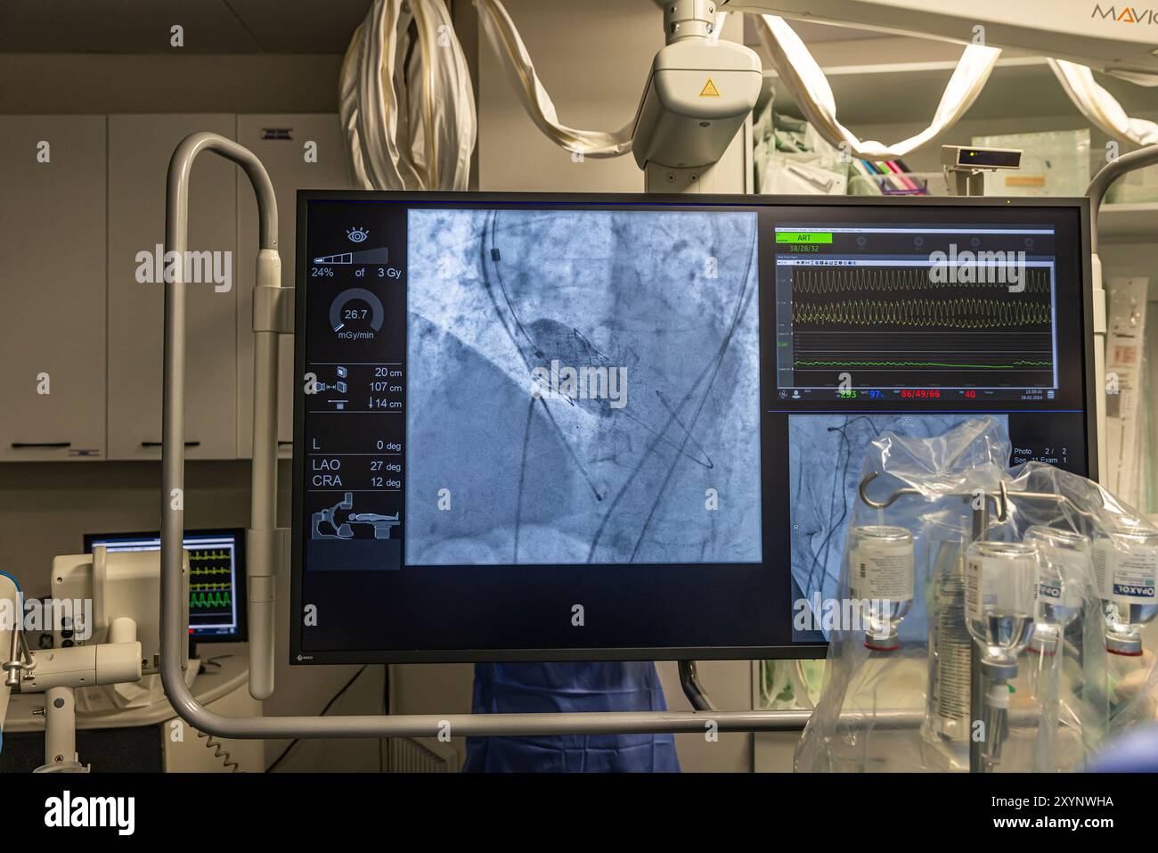 Istanbul, Turquie 29 février 2024 ; radiographie pour remplacement valvulaire avec valve mélodique. Vue d'une dysfonction valvulaire prothétique chez un patient atteint de mi Banque D'Images