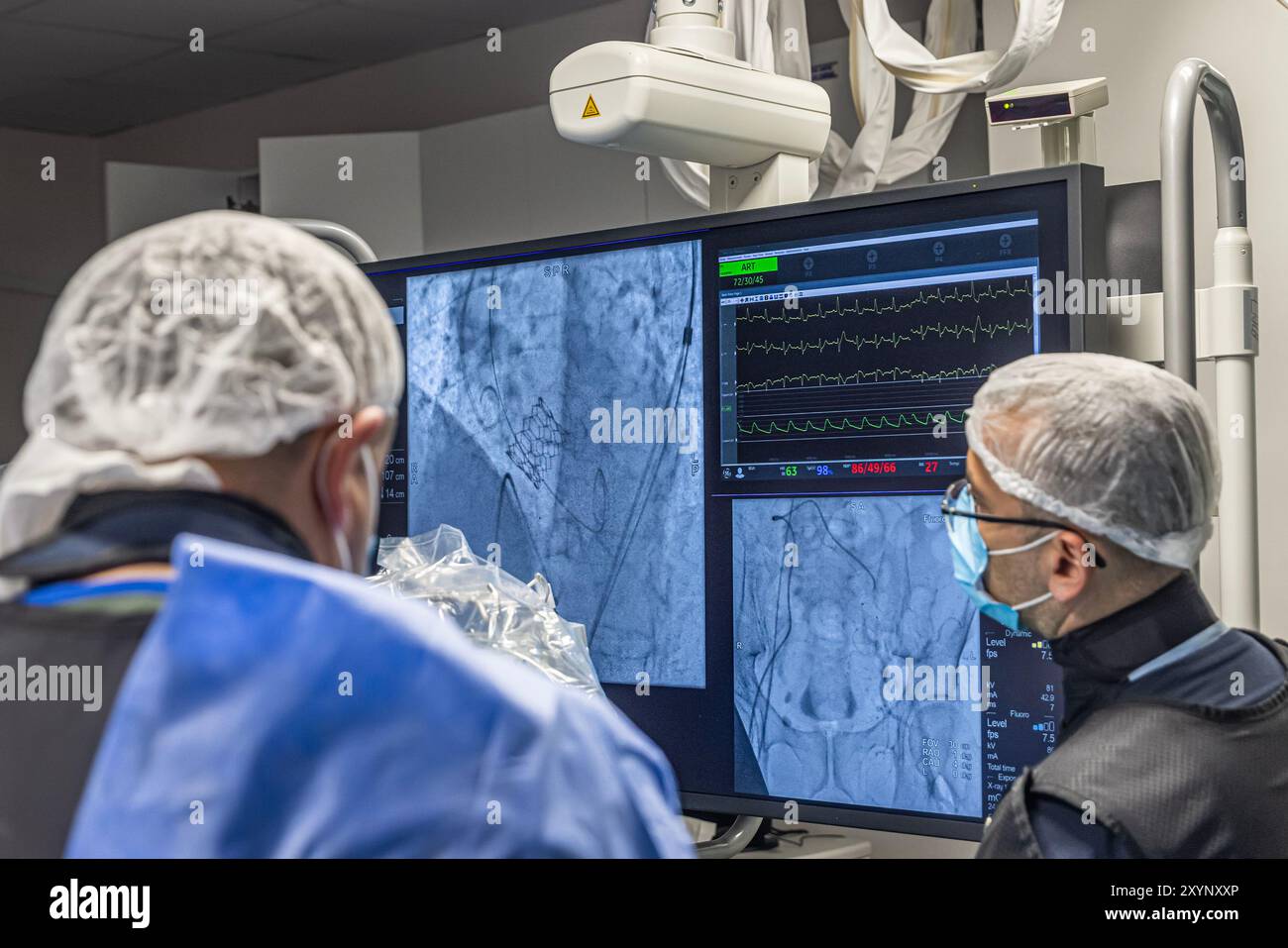 Istanbul, Turquie 29 février 2024 ; radiographie pour remplacement valvulaire avec valve mélodique. Vue d'une dysfonction valvulaire prothétique chez un patient atteint de mi Banque D'Images