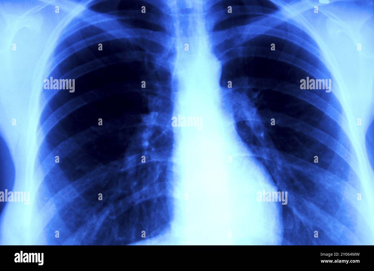 Radiographie du thorax d'un fumeur Banque D'Images
