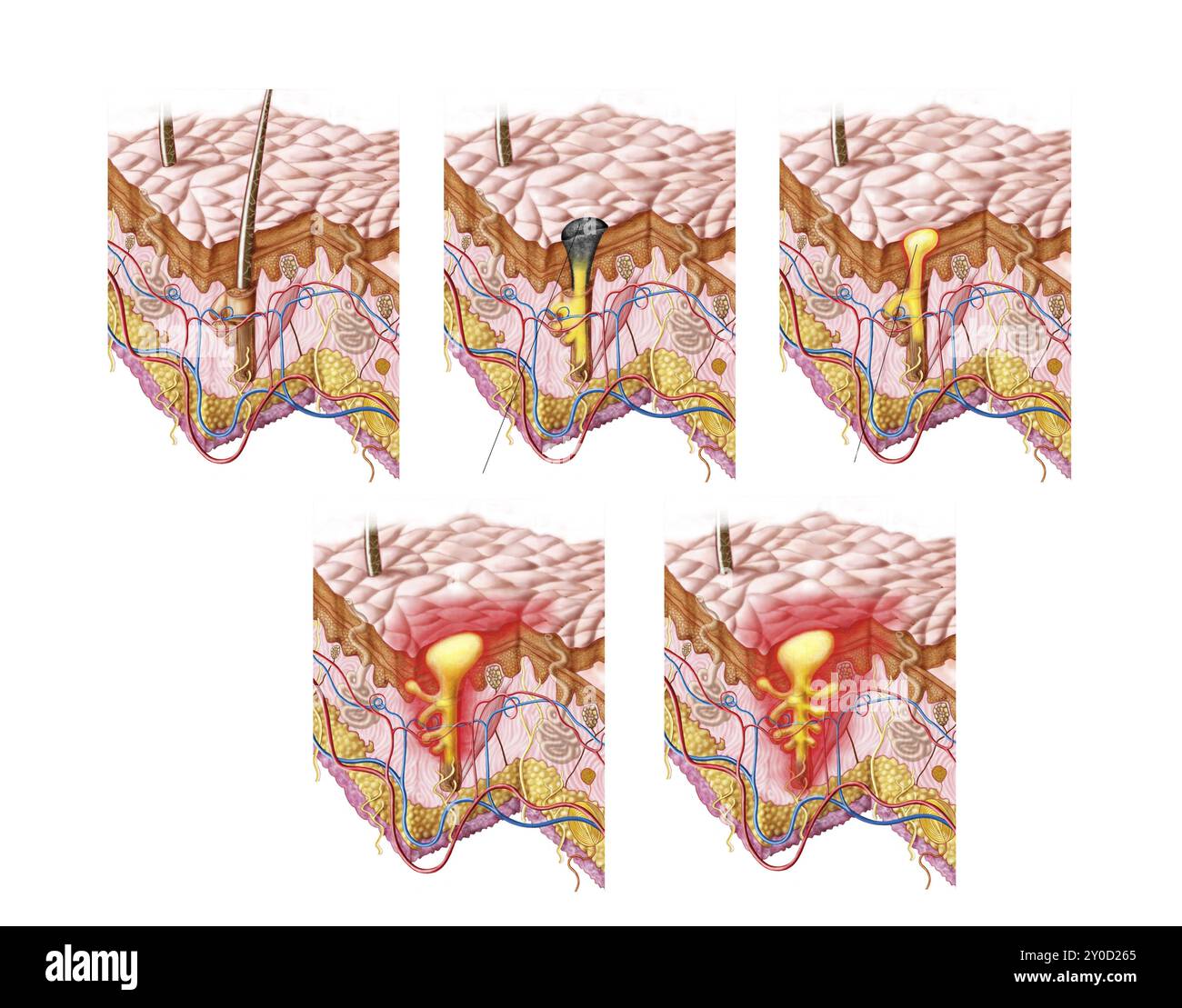 Différents types d'acné, non inflammatoire et inflammatoire Banque D'Images