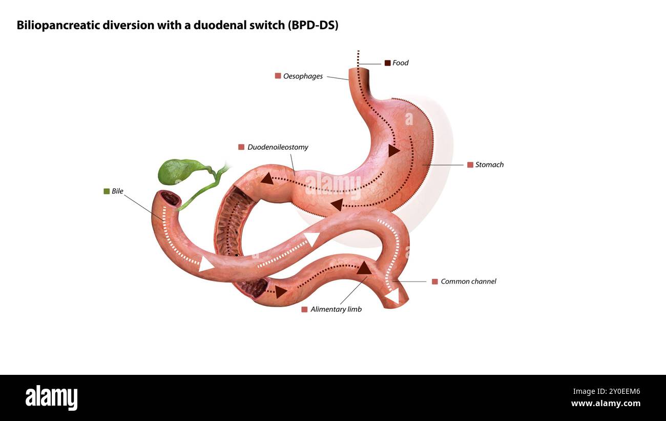 Processus digestif après chirurgie : estomac, voie alimentaire, duodénoiléostomie, débit biliaire, membre alimentaire, canal commun et côlon ascendant, graphique 3d. Banque D'Images