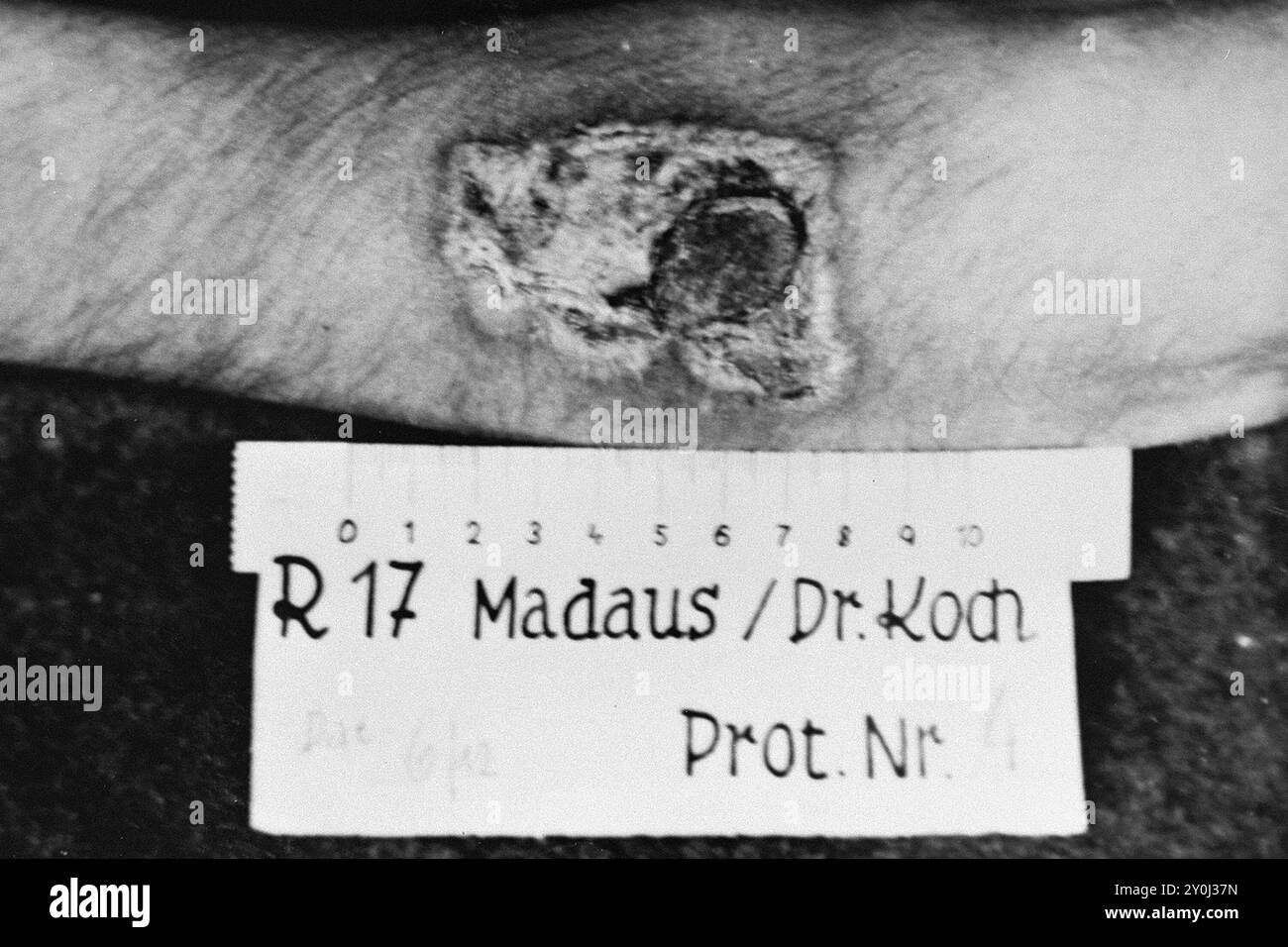 Photographie des résultats d'une expérience médicale sur le phosphore réalisée par des médecins du camp de concentration de Ravensbrück. Dans l'expérience, un mélange de phosphore et de caoutchouc a été appliqué sur la peau et enflammé. Au bout de vingt secondes, le feu a été éteint avec de l'eau puis essuyé avec du R17. Après trois jours, la brûlure a été traitée avec de l'échinacine sous forme liquide. Après deux semaines, la plaie avait guéri. Banque D'Images