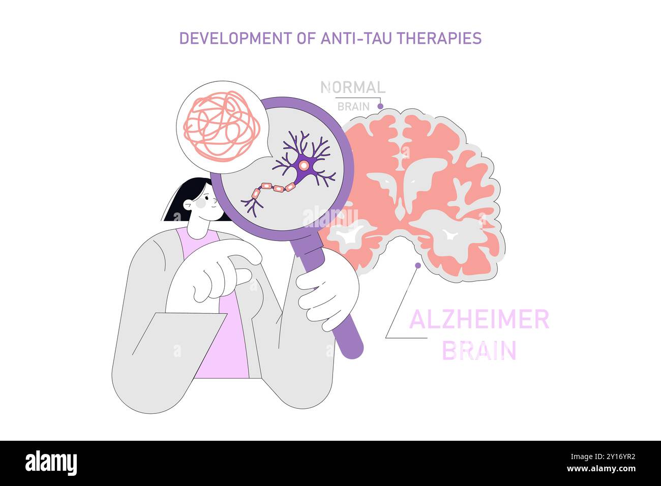 Comparaison du cerveau de la maladie d'alzheimer Banque de ...