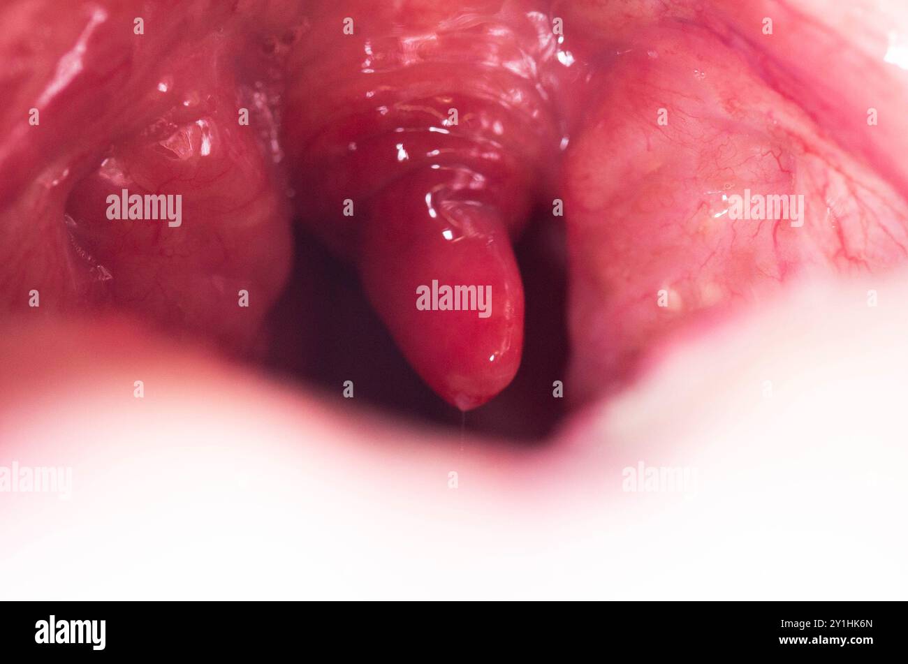 Uvulite et mal de gorge dans la cavité buccale dus à la maladie. Inflammation de la luette et des amygdales due à des infections pendant la maladie, gros plan Banque D'Images