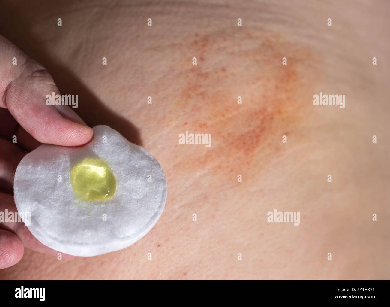 La main d un homme tient un coton avec un gel médical médicinal sur le fond d une bosse et d ecchymose après une injection. Traitement de la post-injection Banque D'Images