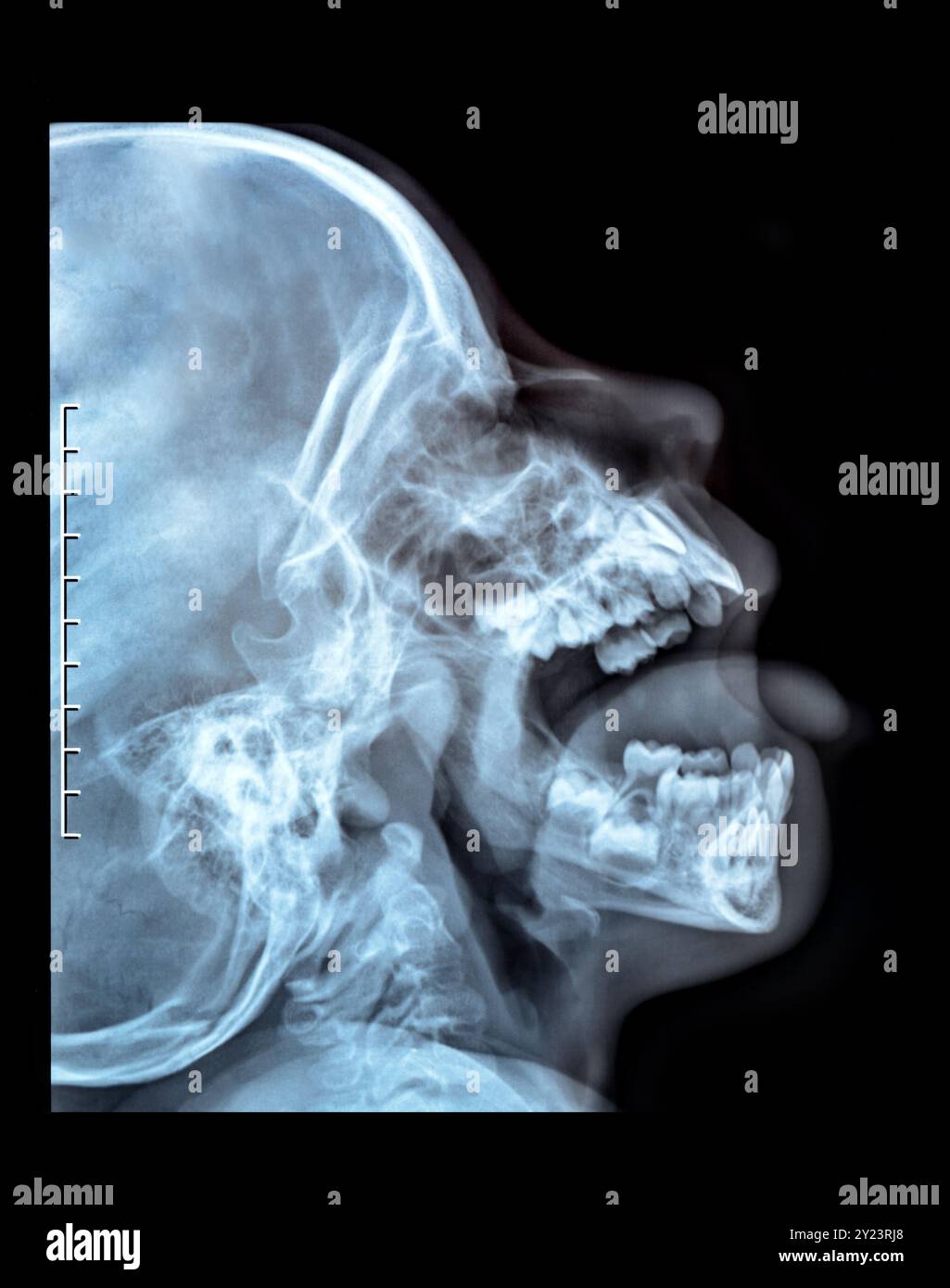 Radiographie d'un crâne de la personne. Radiographie luxée des os brisés de la mâchoire nasopharynx de haute qualité Banque D'Images