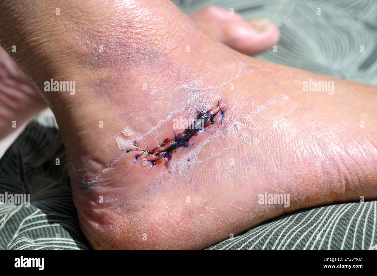 Cicatrice après une opération avec points de suture, après une fracture osseuse du talon Banque D'Images