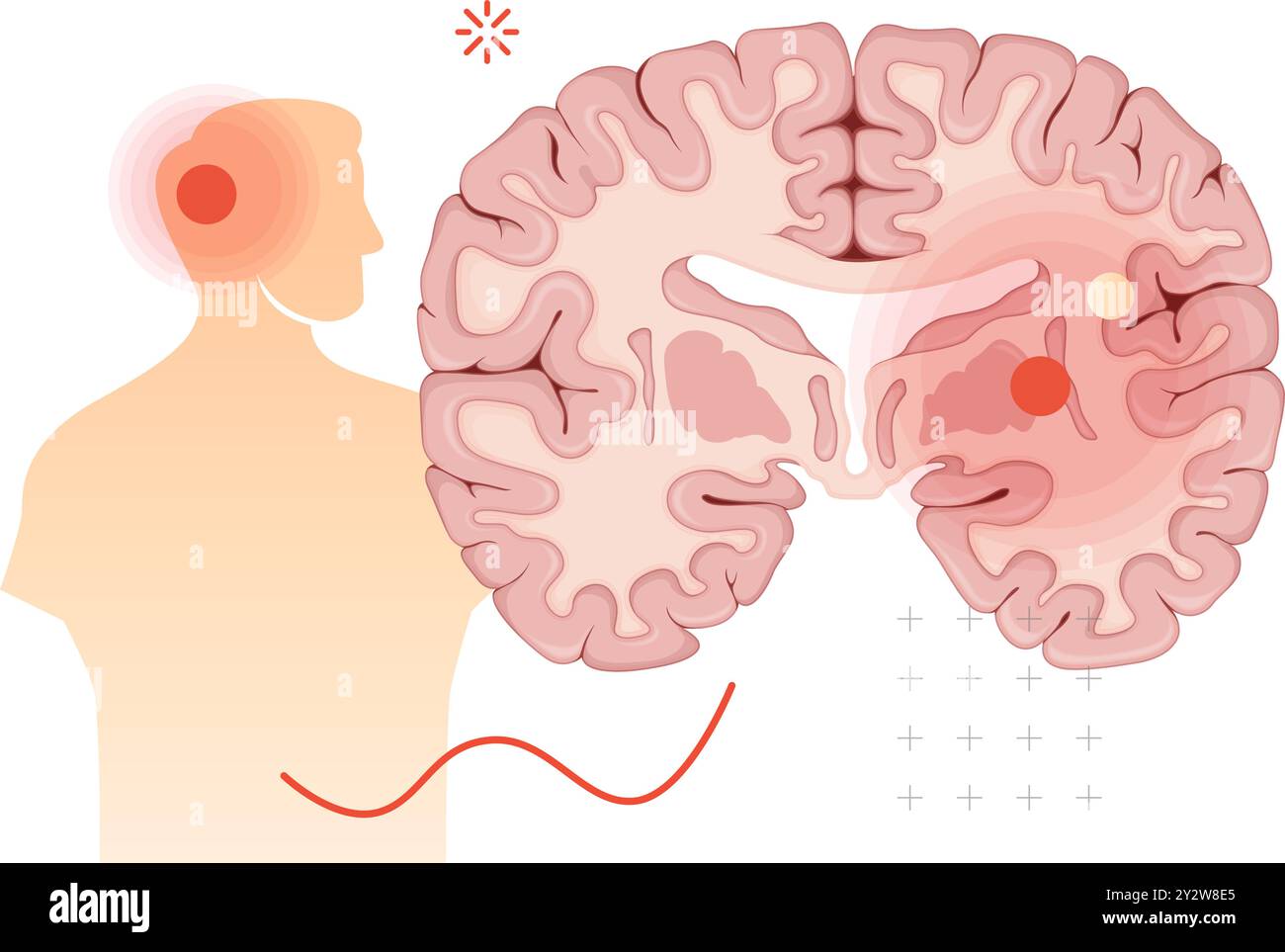 Inflammation des ganglions de la base - section transversale du cerveau - illustration sous forme de fichier EPS 10 Illustration de Vecteur