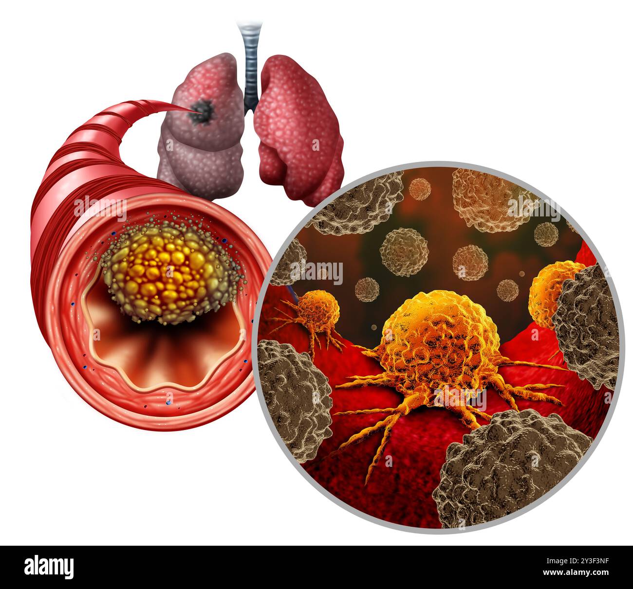 Cancer du poumon à petites cellules comme une tumeur maligne centrale croissance comme une métastase se développant dans les poumons d'une bronche comme une maladie bronchique se propageant dans le Banque D'Images