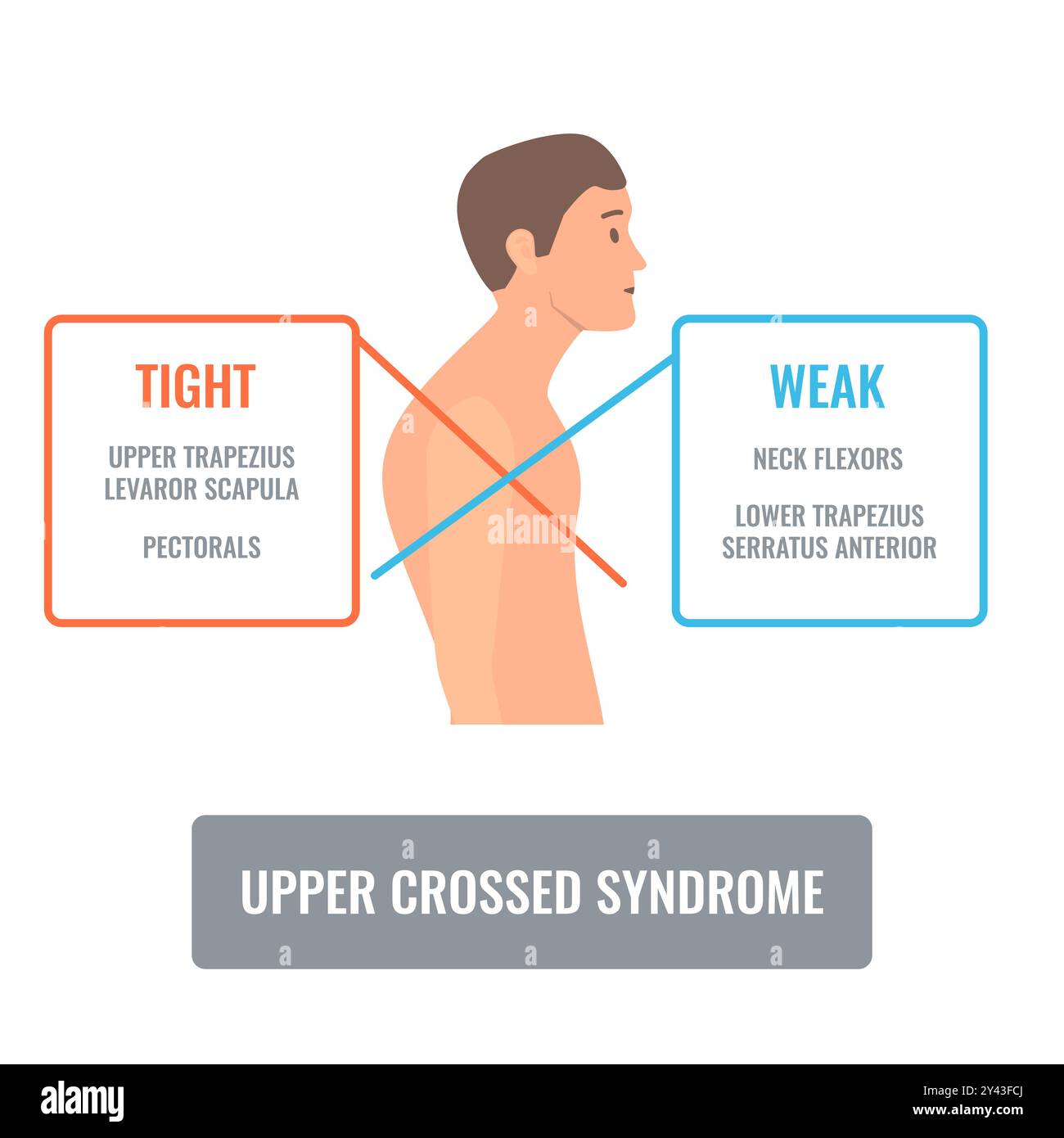 Homme de travers avec déséquilibre du syndrome croisé supérieur Illustration de Vecteur