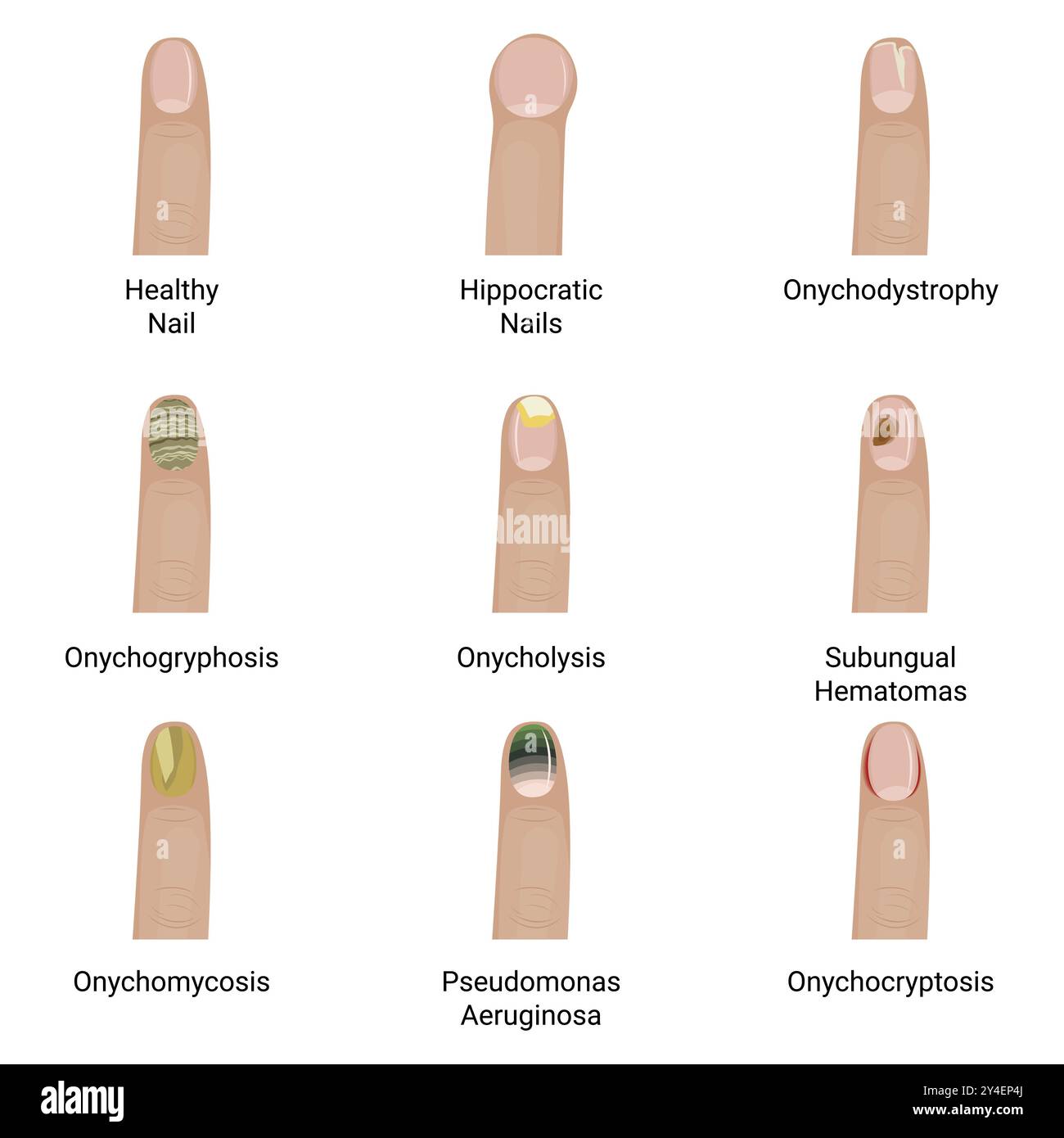 Conception d'illustration vectorielle de maladies des ongles. Illustration de Vecteur