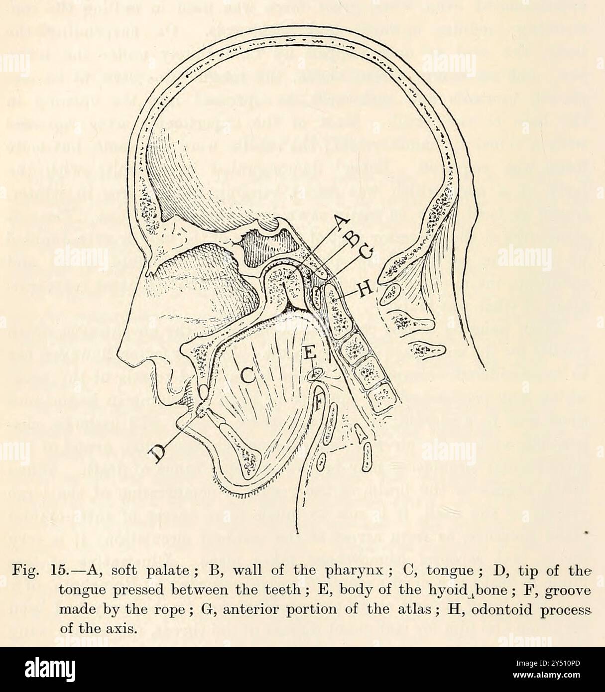 Un homme pendu A. palais mou ; B, paroi du pharynx ; C, langue ; d, pointe de la langue pressée entre les dents ; E, corps de l'os hyoïde ; F, rainure réalisée par la corde ; G, partie antérieure de l'atlas ; H, apophyse odontoïde de l'axe. Tiré de la médecine légale et de la toxicologie de Mann, J. Dixon (John Dixon), 1840-1912 date de publication 1898 publié par Charles Griffin Banque D'Images