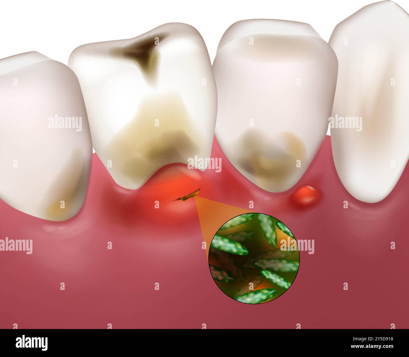 Gingivite buccale. Maladie des gencives ou inflammation des gencives due à la gingivite. Maladie parodontale. Illustration de Vecteur