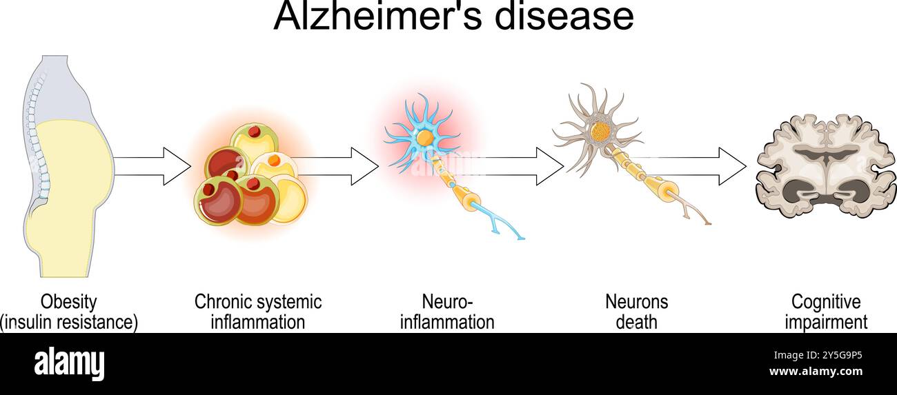 Maladie d'Alzheimer et insulinorésistance. Déclin cognitif. De l'obésité, l'inflammation systémique chronique à la mort des neurones après Neuro-inflammation an Illustration de Vecteur
