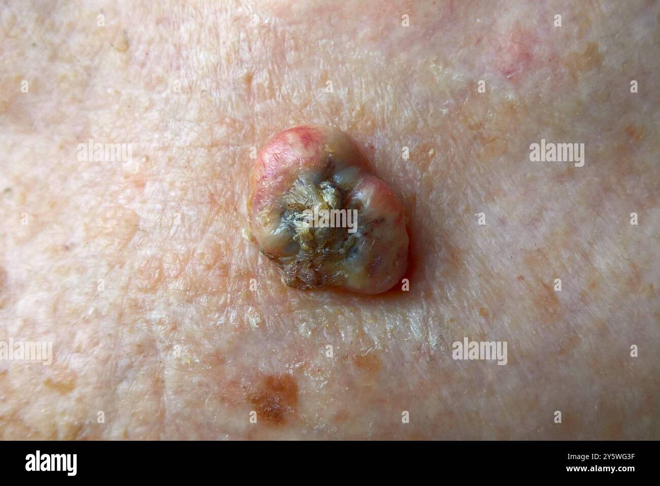 Entzündete Stellen oder sich verändernde Muttermale sollten regelmässig vom Dermatologen bzw. Hautarzt begutachtet werden. Die Vorsorgeuntersuchung im Bereich Hautkrebs betrifft nicht nur Menschen mit empfindlicher Haut. Foto : Plattenepithel. DAS kutane Plattenepithelkarzinom, kurz PEK, ist ein malin tumeur der epidermis mit mit lokal destruierendem Wachstum und relativ geringer Metastasierungstendenz *** les zones enflammées ou les grains de beauté changeants doivent être régulièrement examinés par un dermatologue ou un dermatologue le dépistage du cancer de la peau ne concerne pas seulement les personnes avec peau sensible cellule squameuse photo Banque D'Images