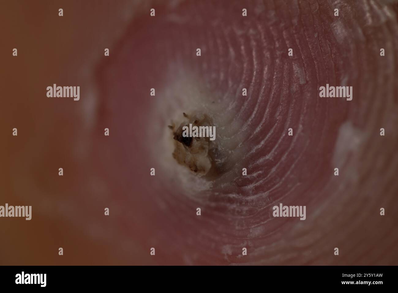 Macro verrue plantaire en gros plan infection à HPV. Banque D'Images