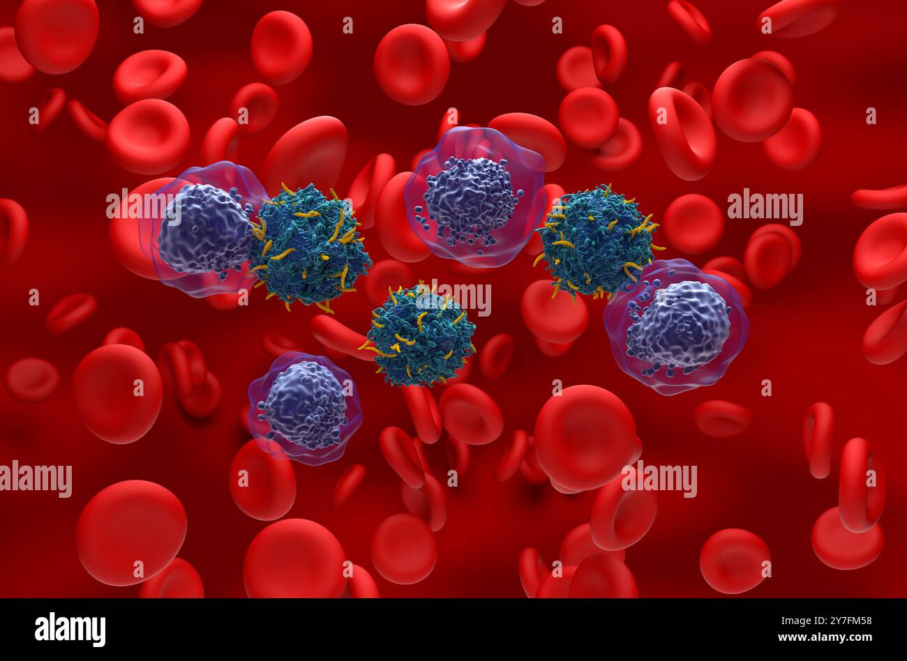 Thérapie par les cellules CAR T dans la leucémie myéloïde aiguë (LAM) - vue isométrique illustration 3D. Banque D'Images