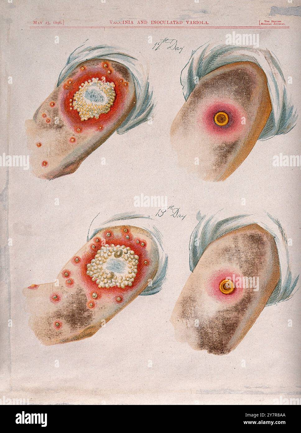 Illustration vintage d'une comparaison entre la variole et les pustules de la variole aux douzième et treizième jours de la maladie. Chromolithograph, 1896, d'après G. Kirtland. Banque D'Images