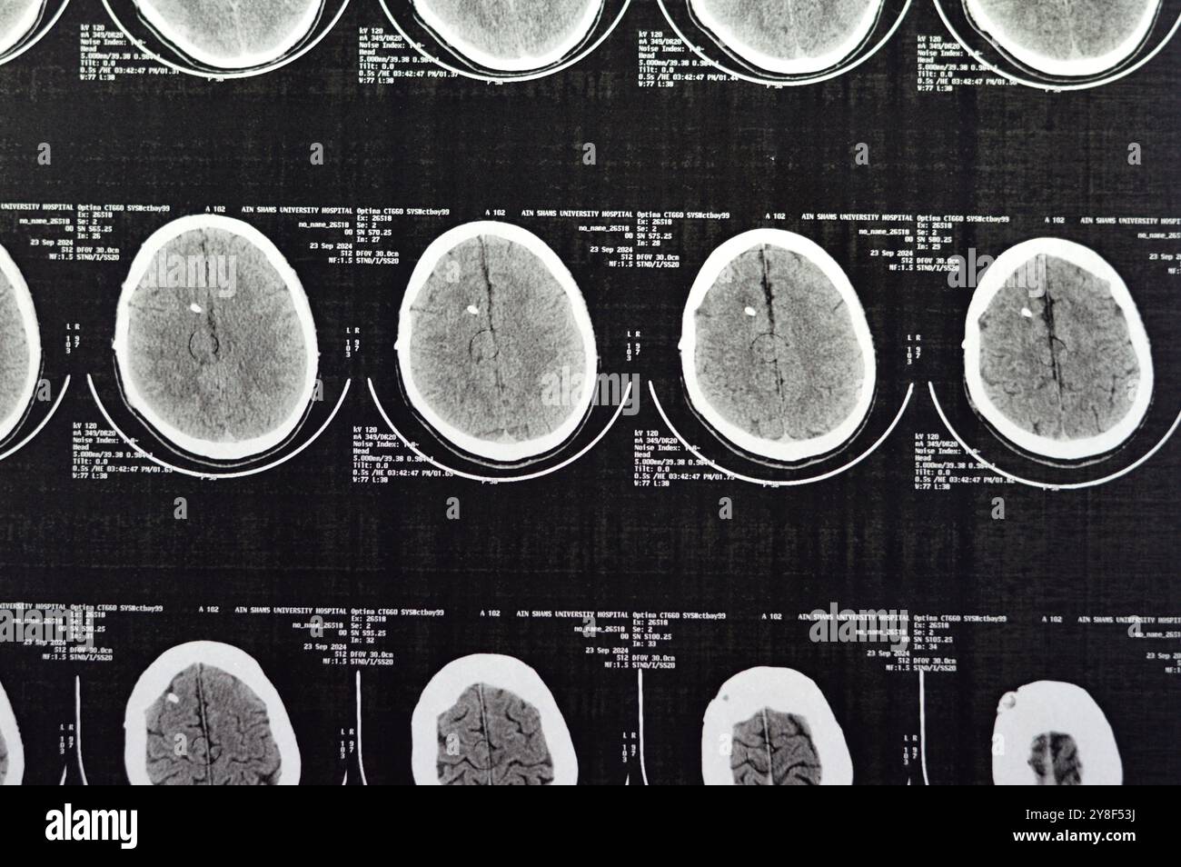 Le Caire, Egypte, septembre 26 2024 : un cas d'hydrocéphalie avec tube de dérivation, la tomodensitométrie révèle une dilatation légère à modérée de l'ensemble du syste ventriculaire Banque D'Images