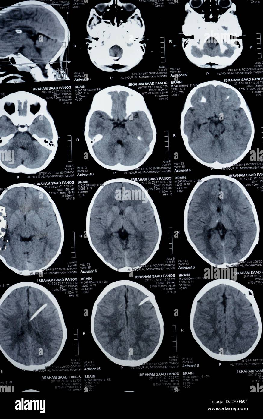 Le Caire, Égypte, 17 septembre 2024 : la tomodensitométrie cérébrale révèle que le shunt gauche se termine dans le ventricule latéral droit, sans dilatation ventriculaire résiduelle Banque D'Images