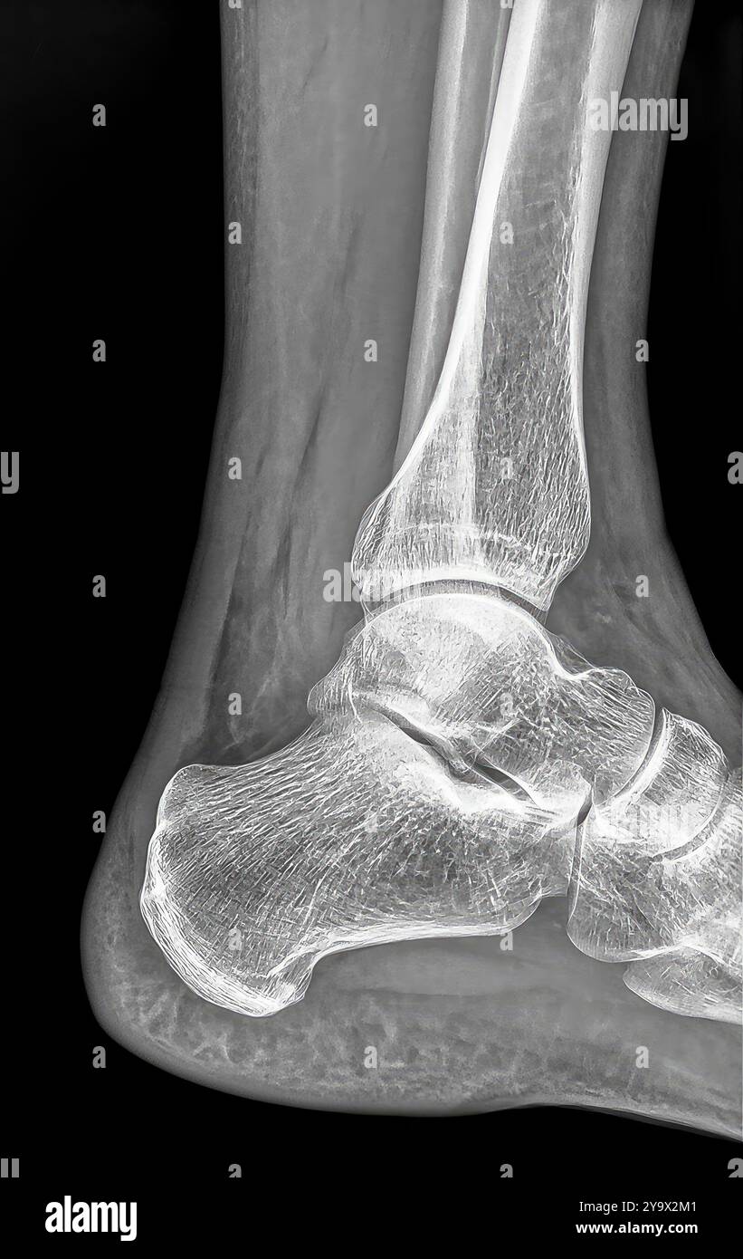 Radiographie détaillée de la structure osseuse du pied et de la cheville chez l'homme avec mise en évidence de la fracture de la malléole latérale, utile pour le diagnostic et le traitement médicaux Banque D'Images