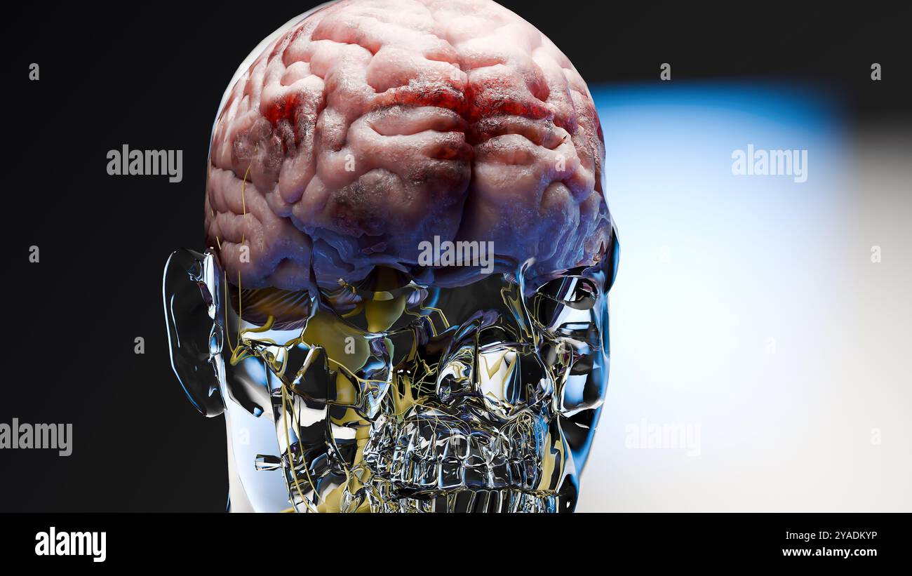 Anatomie du système nerveux du cerveau humain, cancer neural, bulbe sébacé, cancer du cerveau croissance et propagation des cellules malignes tumorales, méningiome, neurologique d Banque D'Images