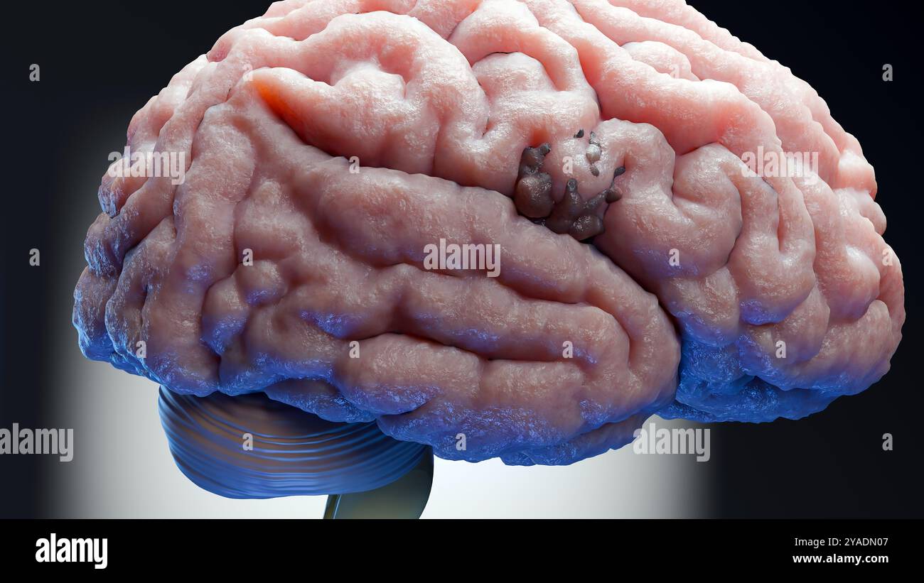 Anatomie du système nerveux du cerveau humain, cancer neural, bulbe sébacé, cancer du cerveau croissance et propagation des cellules malignes tumorales, méningiome, neurologique d Banque D'Images