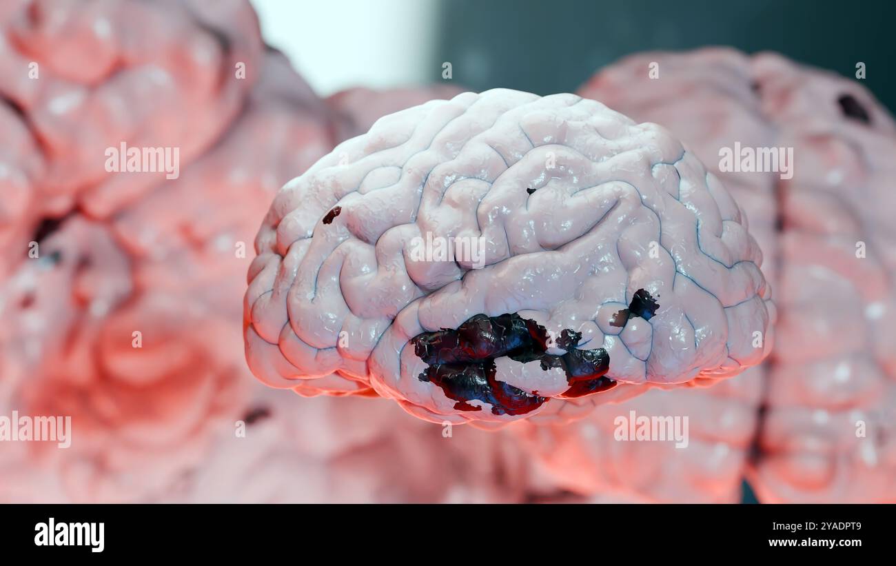 Anatomie du système nerveux du cerveau humain, cancer neural, bulbe sébacé, cancer du cerveau croissance et propagation des cellules malignes tumorales, méningiome, neurologique d Banque D'Images