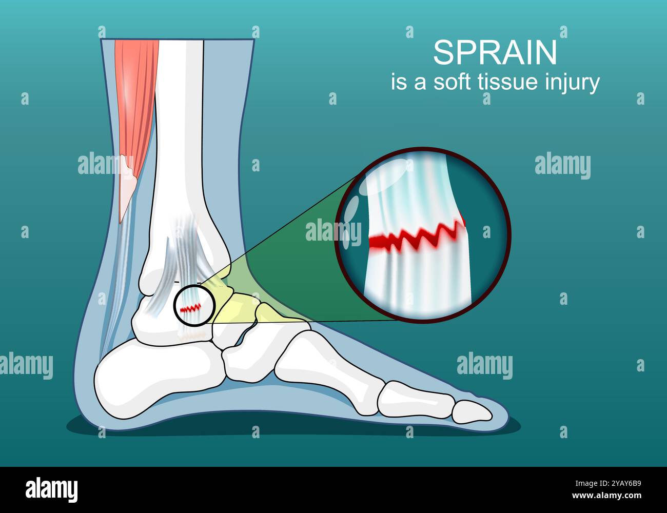 Entorse du ligament de la cheville. Gros plan d'une lésion ligamentaire des tissus mous. Articulation du pied. Illustration plate isométrique. Affiche vectorielle Illustration de Vecteur
