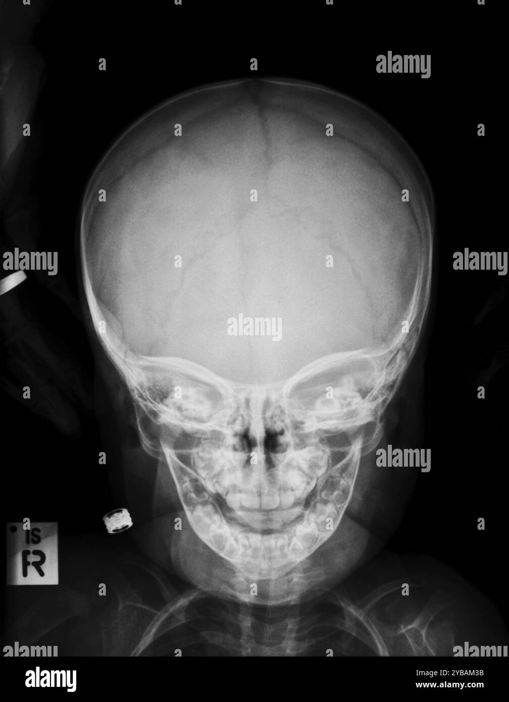 Crâne d'enfant, radiographies après accident sans constat Banque D'Images