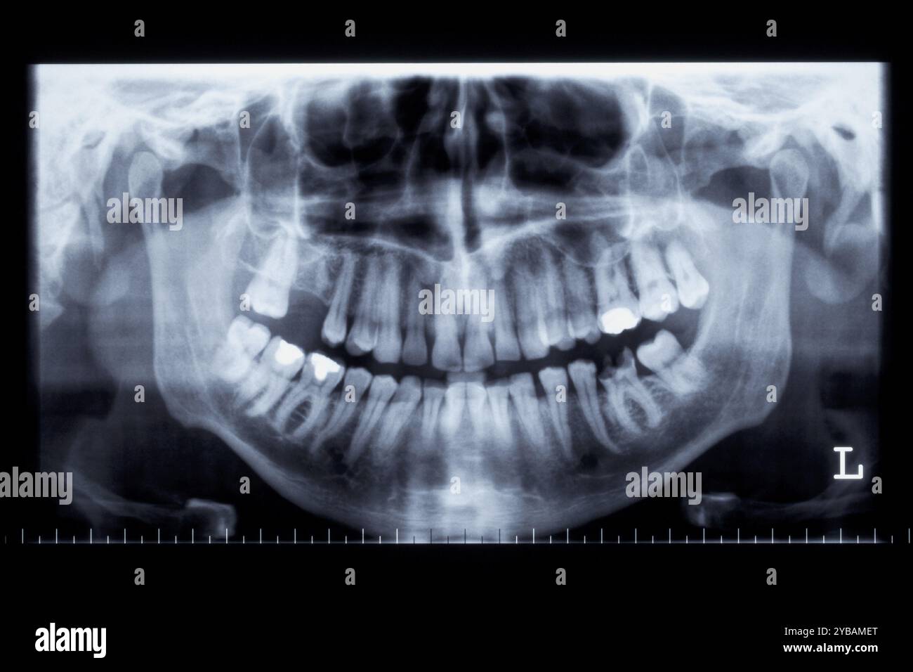 Radiographie panoramique d'une mâchoire humaine Banque D'Images