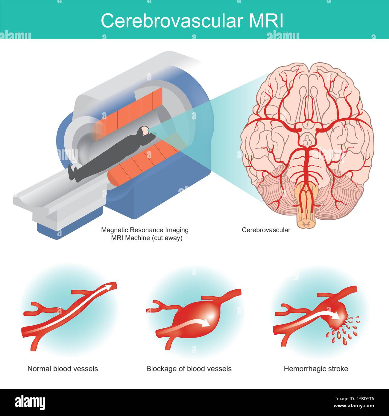 IRM cérébrovasculaire. l'imagerie cérébrale par machine spéciale est utile pour l'évaluation d'un large éventail de maladies cérébrovasculaires. Banque D'Images