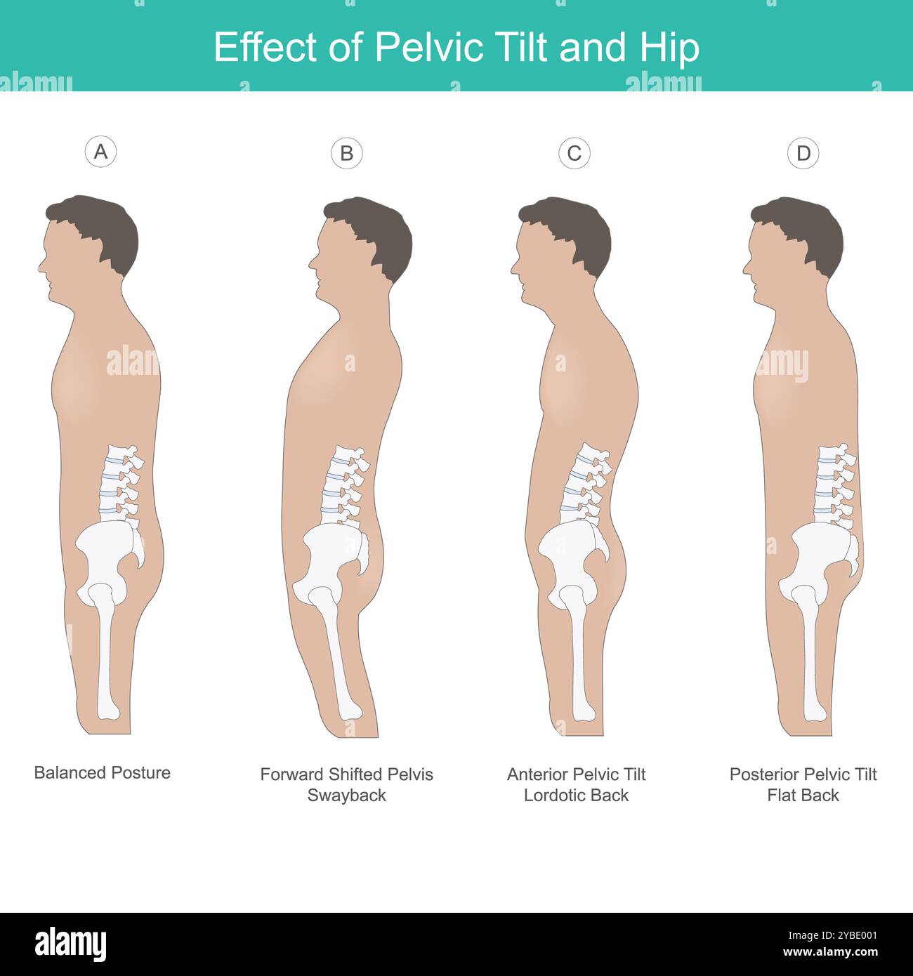 Effet de l'inclinaison pelvienne et de la hanche. Comparaison de l'os du bassin et des hanches dans la bonne position physiologie humaine. Banque D'Images