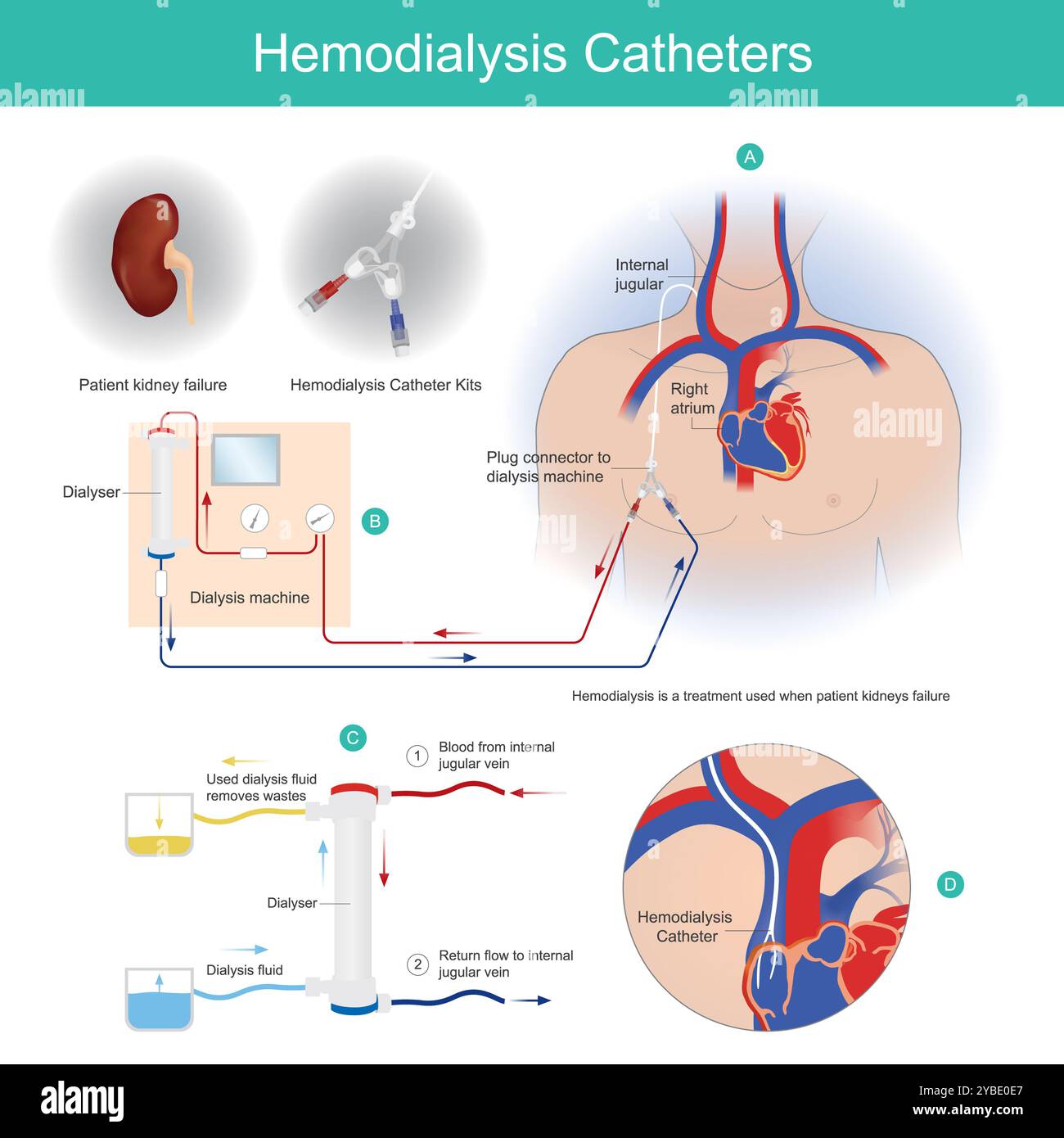 Cathéters d'hémodialyse. Un cathéter de dialyse est un cathéter utilisé pour échanger du sang du cœur vers et depuis une machine d'hémodialyse et un patient. Banque D'Images