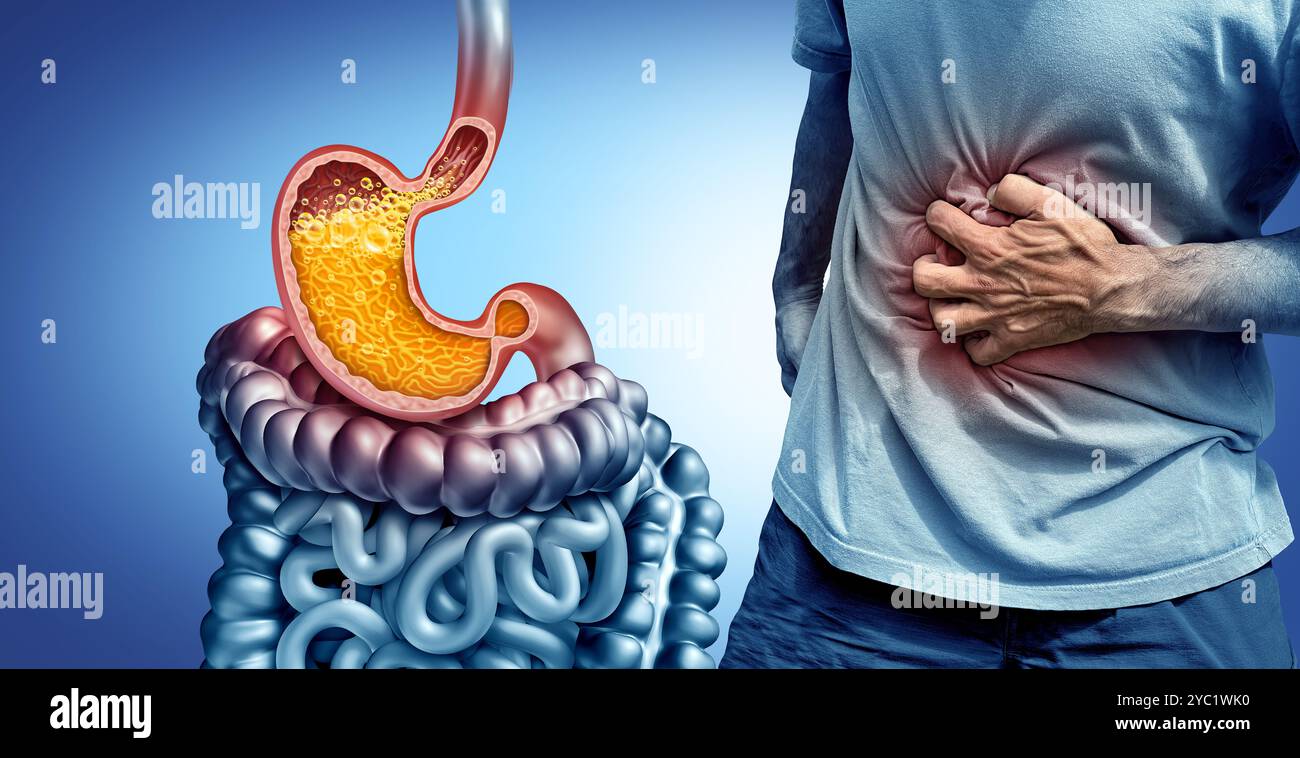 Brûlures d'estomac et reflux acide ou maladie gastro-œsophagienne ou RGO comme un sphincter ouvert avec un œsophage iflammé comme symbole médical de régurgitation Banque D'Images