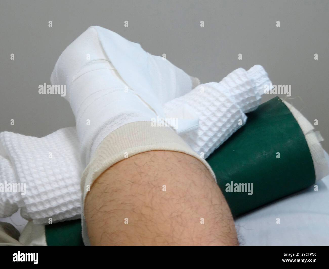 Plâtre pour fracture de la cheville Banque D'Images