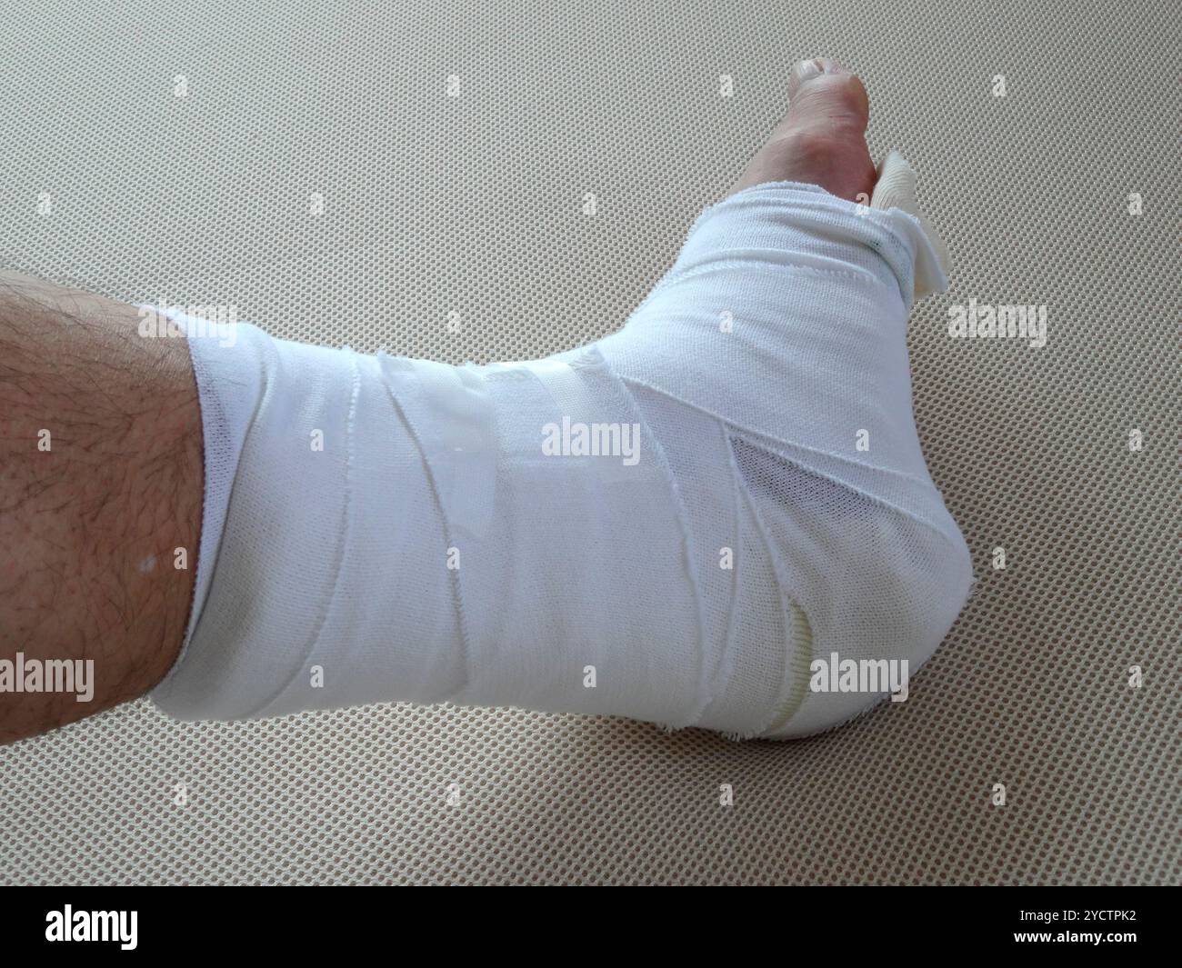 Plâtre pour fracture de la cheville Banque D'Images
