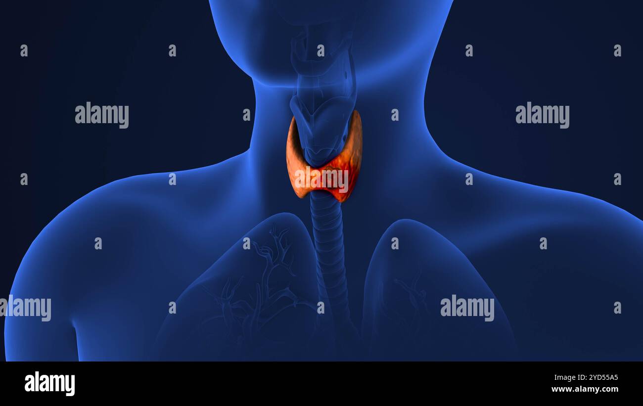Propagation tumorale dans la glande thyroïde Banque D'Images