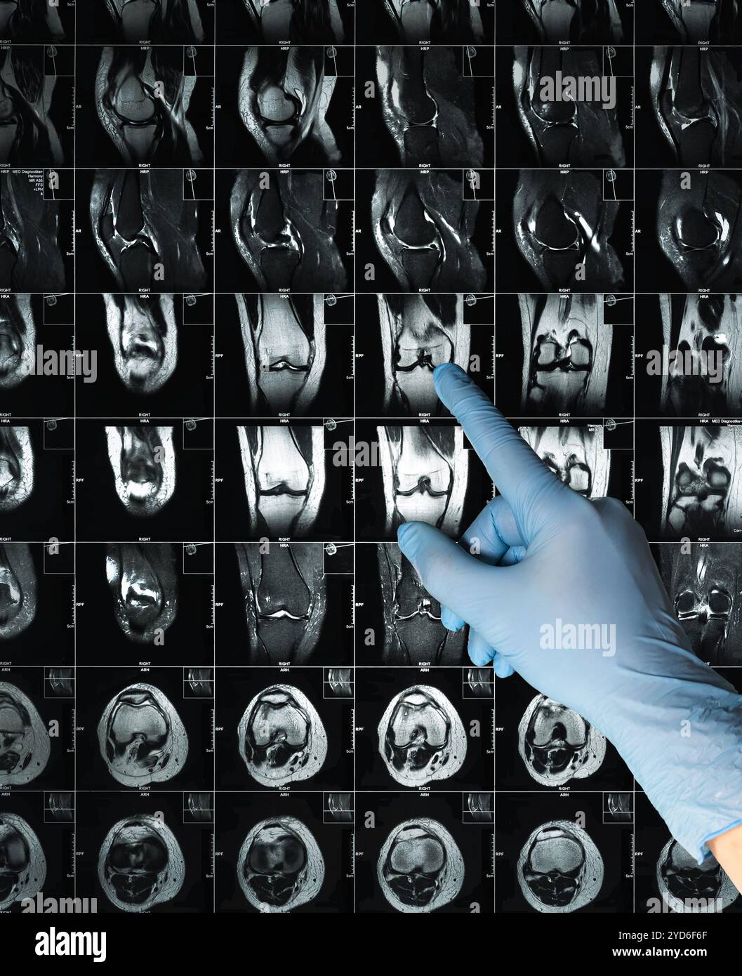 Main dans les points de gant examen IRM images de résonance magnétique montrant une fracture réelle du genou Banque D'Images