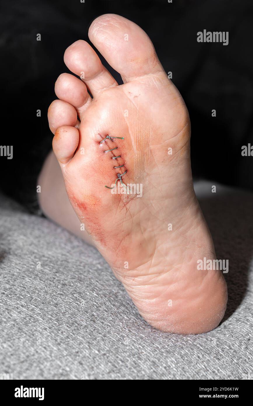 Suture cutanée chirurgicale avec fil après neurectomie ablation chirurgicale de tout ou partie d'un nerf nomme neurome de morton Banque D'Images